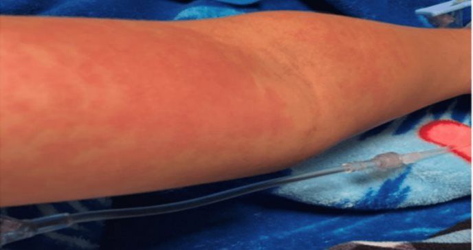 Arm of patient affected by algal dermatitis.