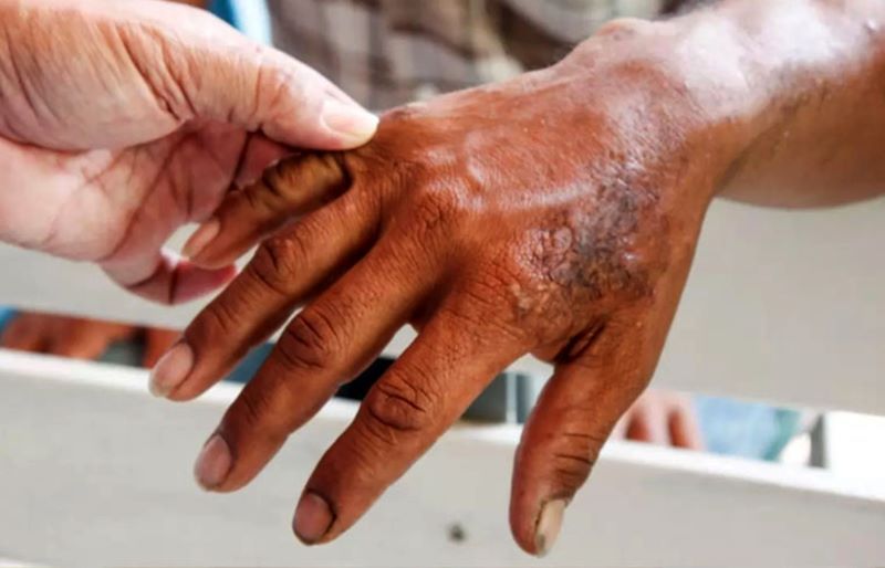Leprosy is a neglected disease.