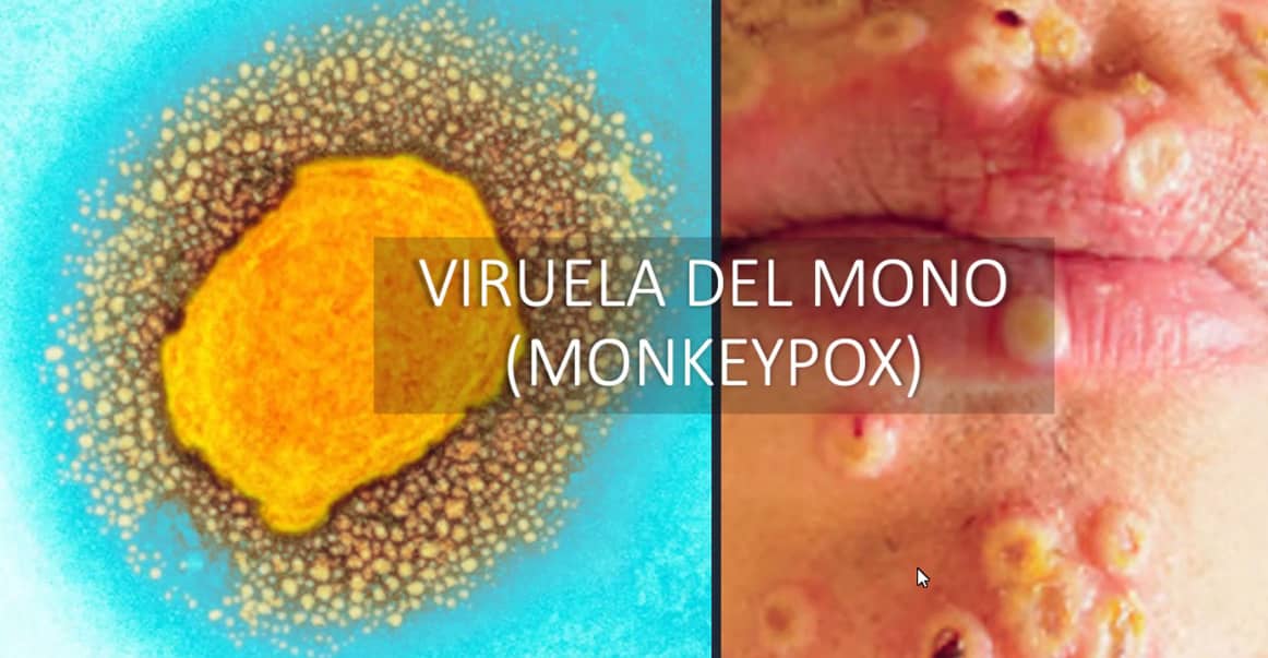 Although hospitalization is ruled out, prevention of monkeypox is urgent