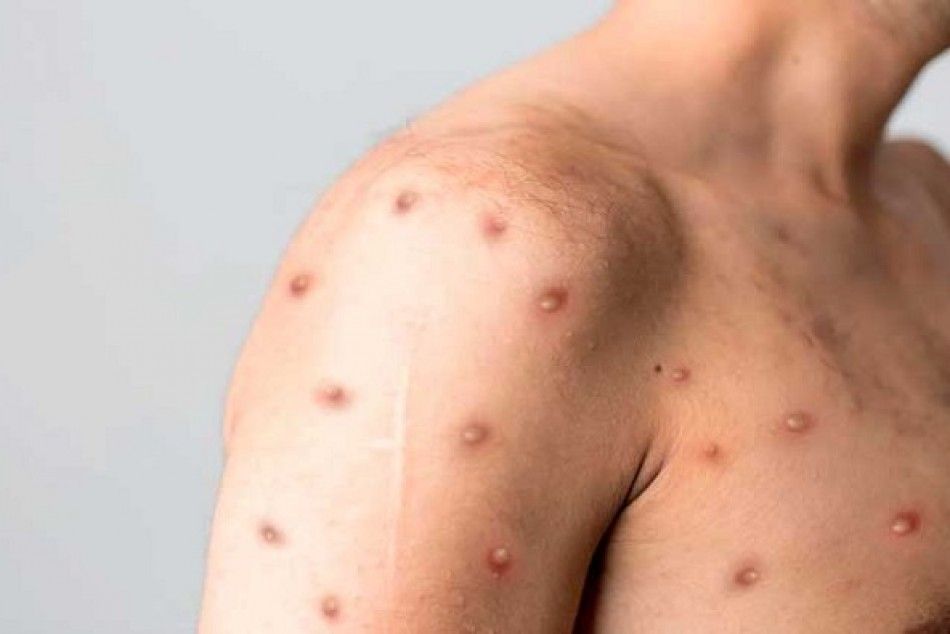 The incidence of monkeypox is growing in Mazatlan.