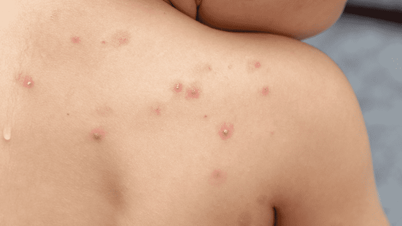 Contagious monkeypox infection in Los Cabos was contracted in the U.S.
